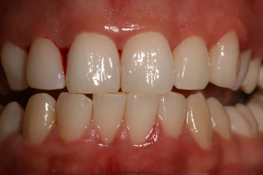 Gingivitis jpg